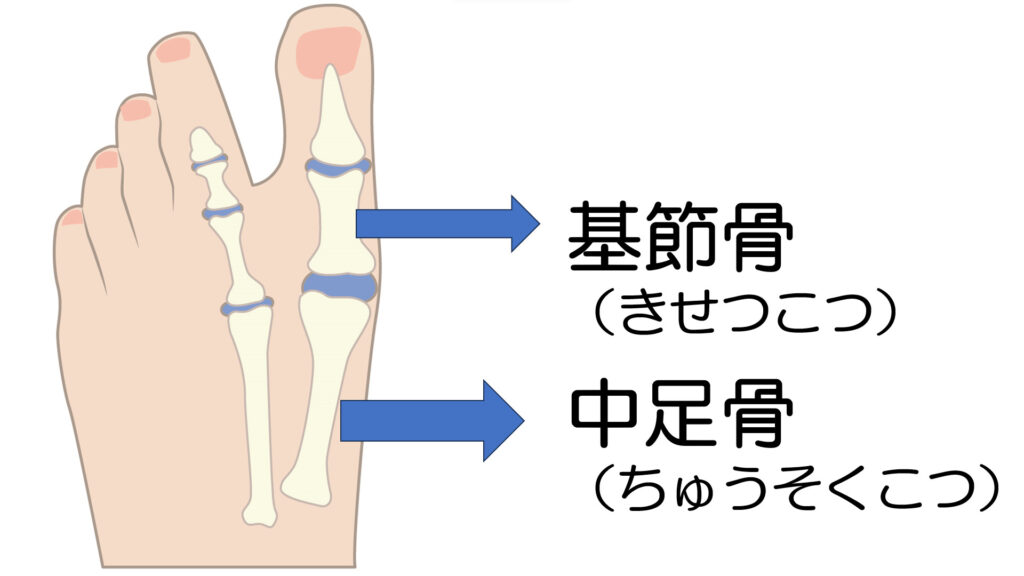 外反母趾の説明のために使用した中足骨と基節骨の説明画像