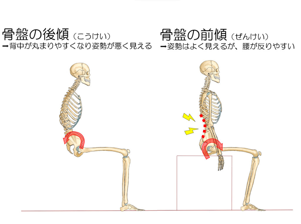 登戸駅から徒歩圏内のよろずや接骨院向ヶ丘遊園院のスタッフが作成した、骨盤の前傾と後傾による姿勢や身体への影響を説明するための画像