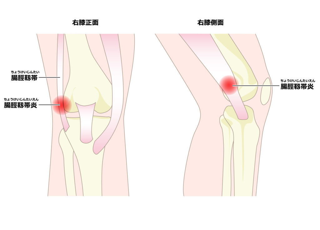 ランナー膝の損傷部位が分かりやすい骨と筋肉と靭帯のイメージ画像