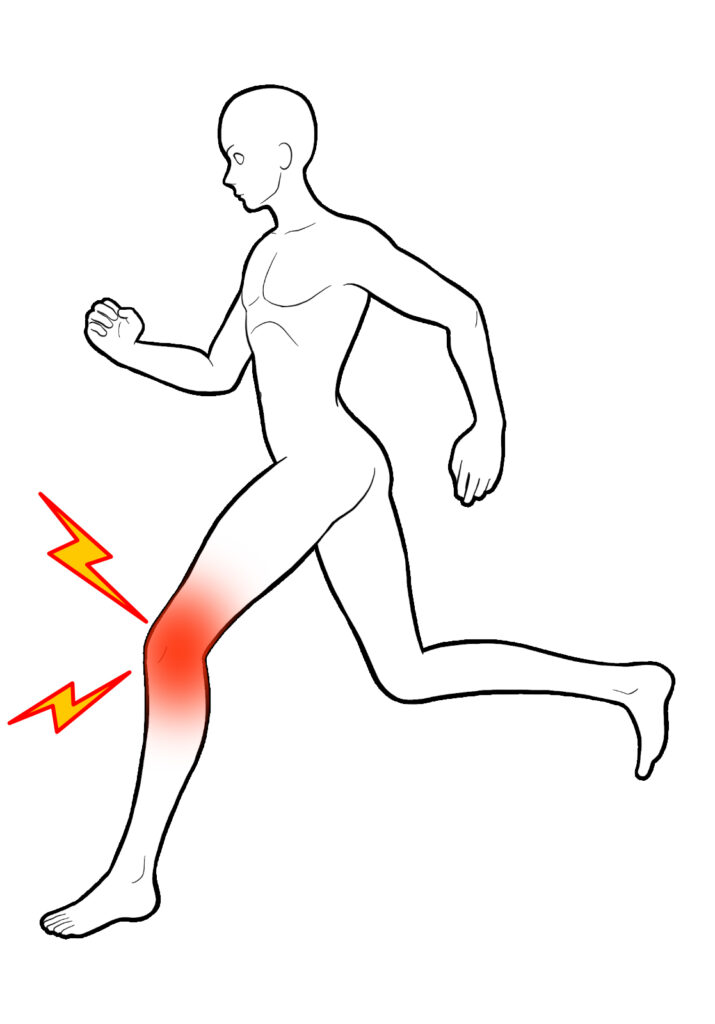 ランナー膝になってしまった人のイメージ画像