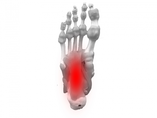 足裏がランニングなどで痛くなる足底筋膜炎の図解