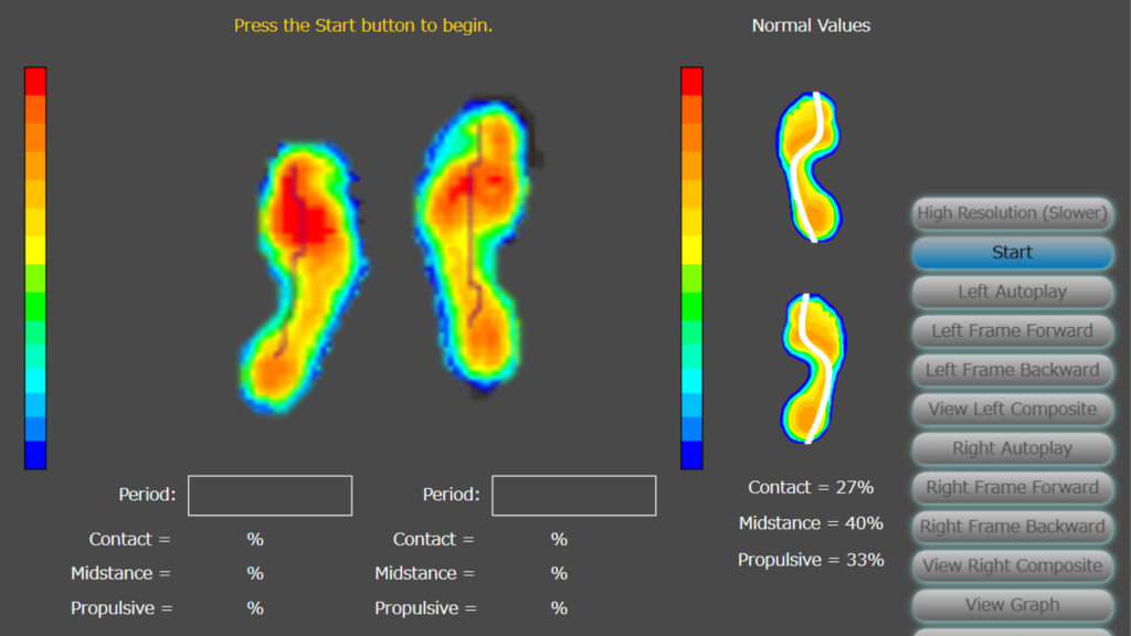 よろずや接骨院向ヶ丘遊園院でインソール作成のために行う足圧測定検査機の検査画面