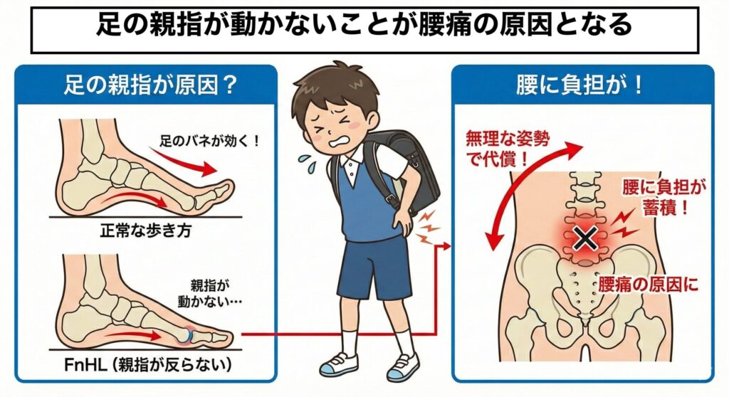 機能的母趾制限が腰痛や坐骨神経痛の原因となることが分かるイラスト
