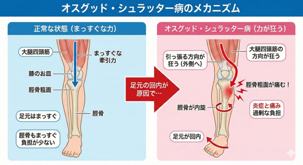 オスグッド・シュラッター病が足の回内によって引き起こされることが一目で分かるイメージ画像
